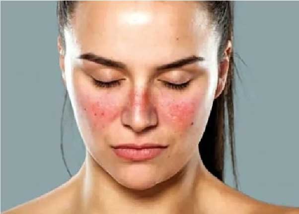 A person holding their face with a soft purple glow and a butterfly design, symbolizing lupus care and awareness